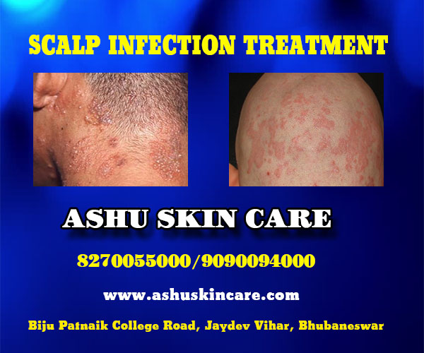 best scalp infection treatment clinic in bhubaneswar near me